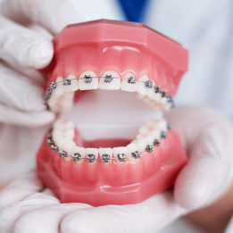braces styles