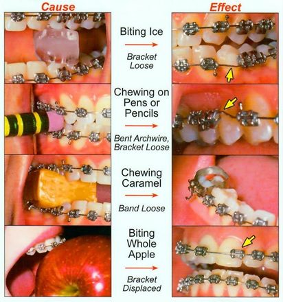 takingcareofbraces